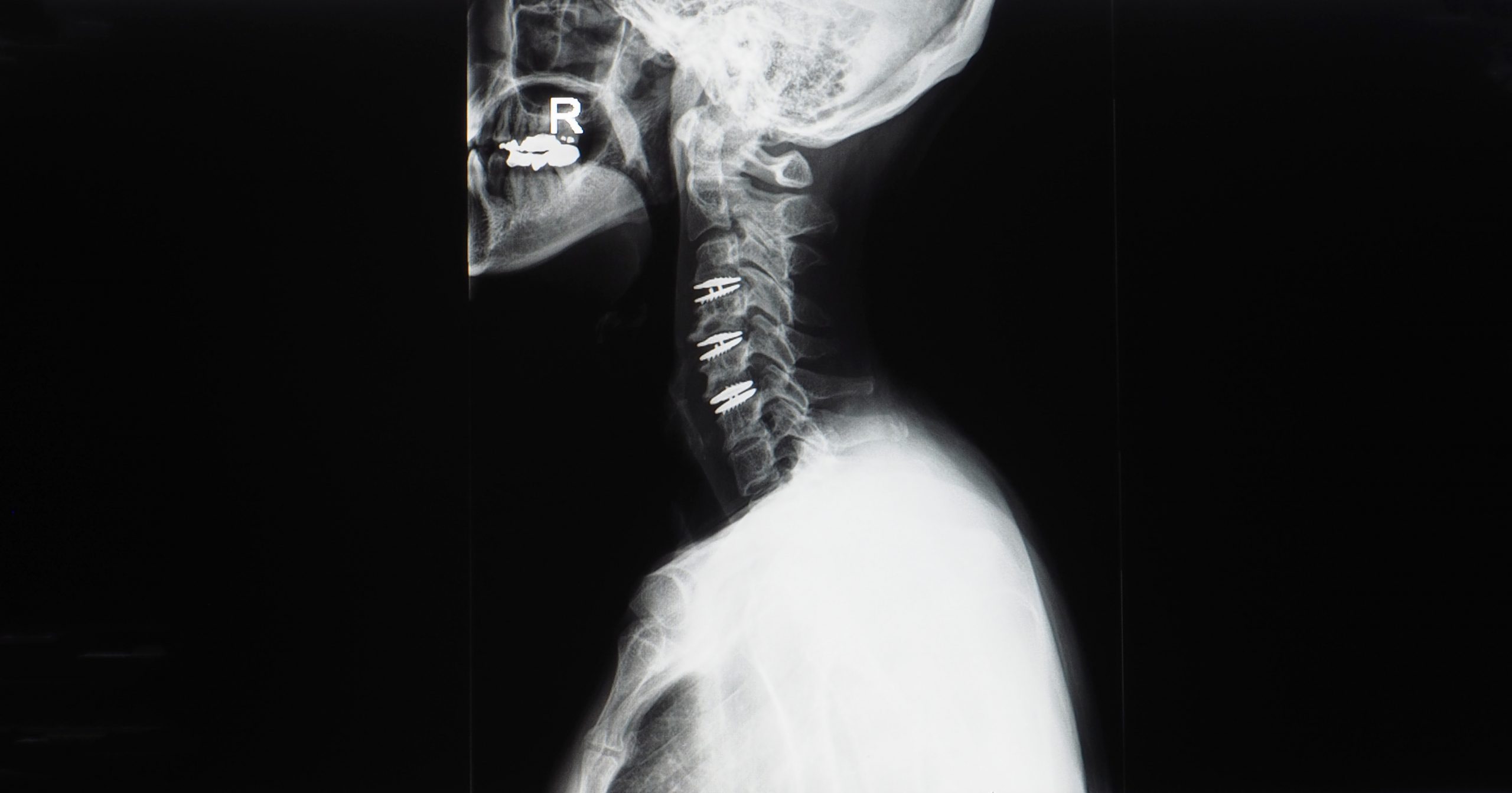 arthroplasty spine surgery