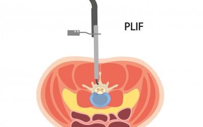 Understanding PLIF Spine Surgery