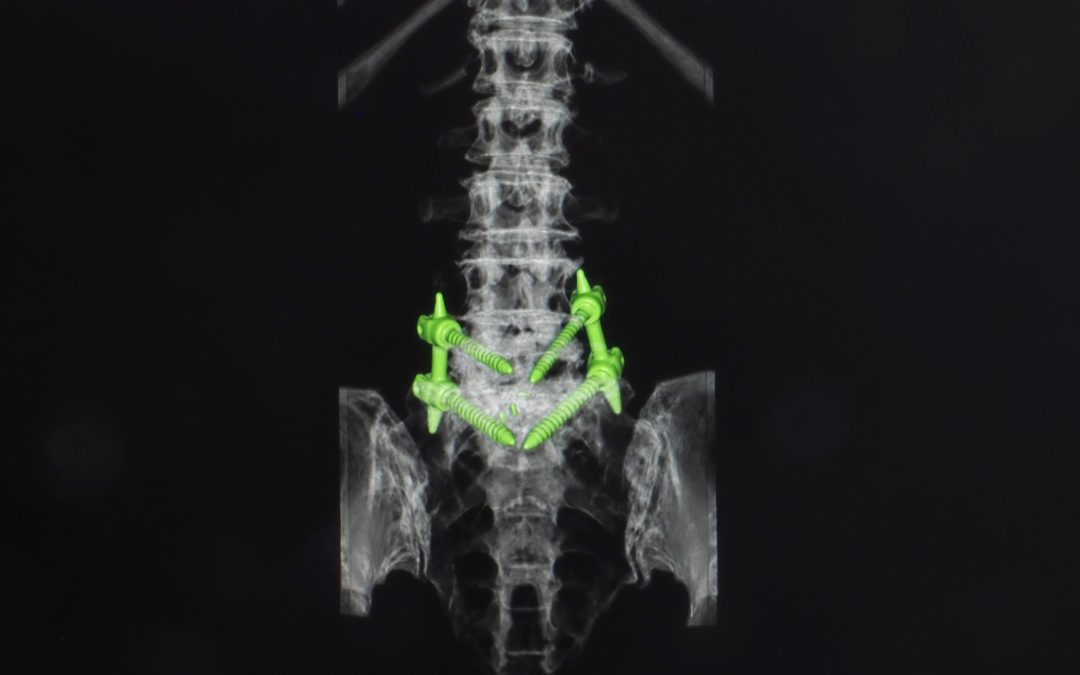 Understanding TLIF in Spine Surgery