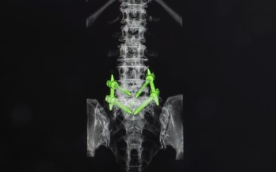 Understanding TLIF in Spine Surgery